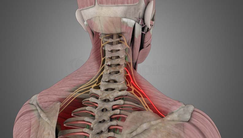 Cervical Radiculopathy Cervical Radiculopathy